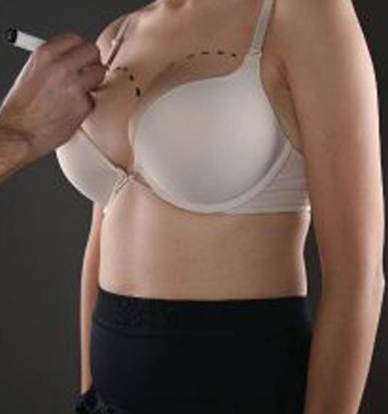 Breast-Augmentation-Or-Breast-Implant