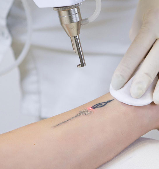 Tattoo-Removal-Treatment